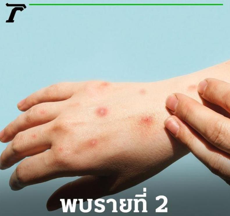 泰国曼谷本土猴痘男性病例 曾与外国男性发生性接触