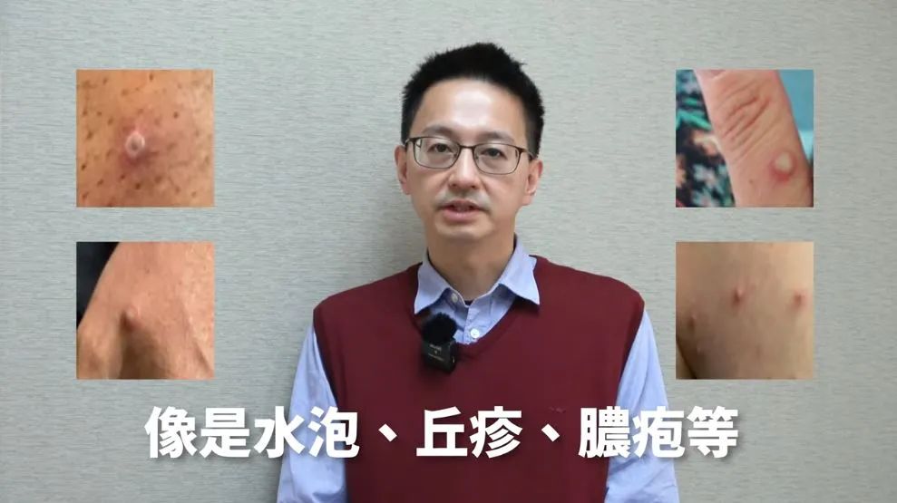 台湾地区出现7宗猴痘“本土病例”