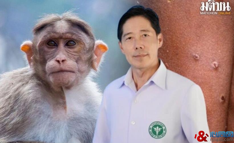 泰国新增3例猴痘患者 曾与陌生男子发生性关系
