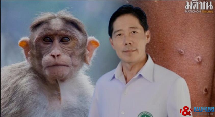 泰国首例猴痘死亡病例！患者同时患有HIV